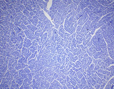 Myocardial Biopsy