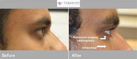 Infraorbital Rim Implant Before and After Photos | Taban MD