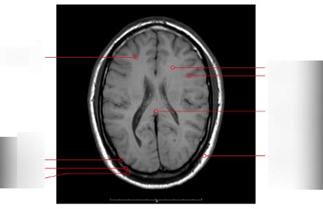 Diagram Radiologie Anatomie Hersenen Quizlet