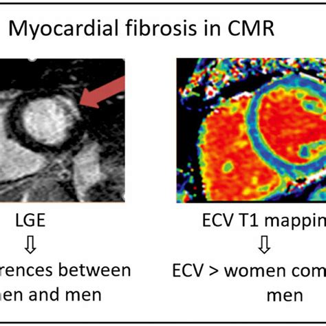 Sex Differences In Expansion Of Myocardial Fibrosis In Aortic Stenosis