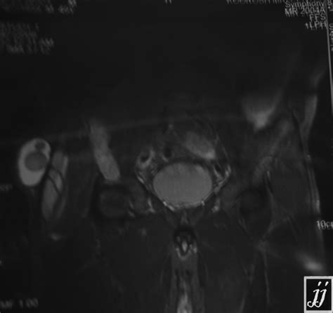 Right Gluteal Region Abscess Radiopaedia