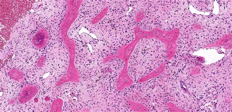 Polyostotic Fibrous Dysplasia Histology