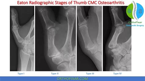 Thumb Cmc Grind Test Orthofixar 2025