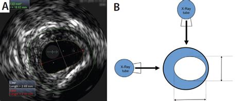 Optimizing Technique For Success A Guide For The Use Of Ivus In