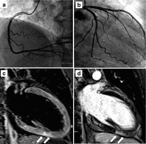 Coronary Angiography And Cmr Imaging Of Patient With Biopsy Proven