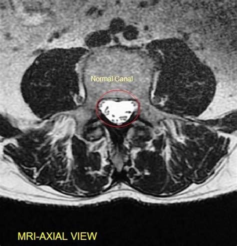 LUMBAR MRI axial spine Diagram | Quizlet