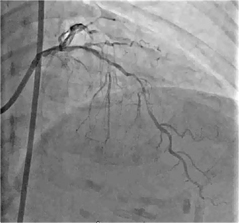 Tctap C 023 Bidirectional Orbital Atherectomy For Treatment Of Diffuse