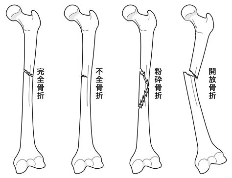 骨折外来診療のご案内HITO病院 愛媛県四国中央市