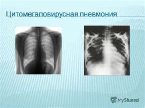 Трансплантация почки - online presentation