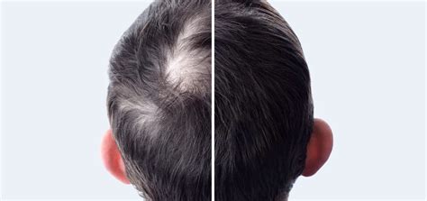 PRP Injections After Hair Transplant: When to Have Them and Why - Face ...