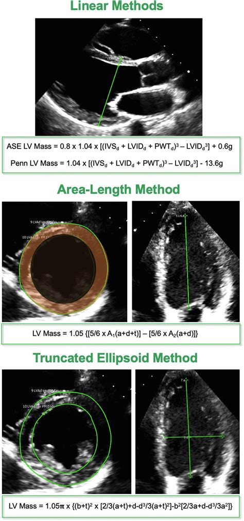 Normal Values Of Left Ventricular Mass By Two Dimensional And Three