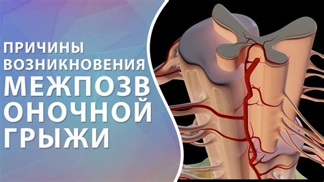 🔴 Причины возникновения межпозвоночной грыжи // Грыжа позвоночника // # ...