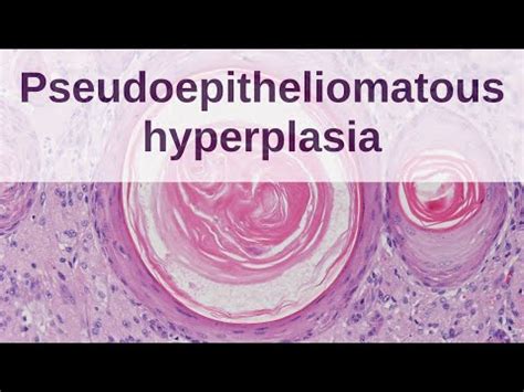 Pseudoepitheliomatous Hyperplasia Pathology Mini Tutorial YouTube