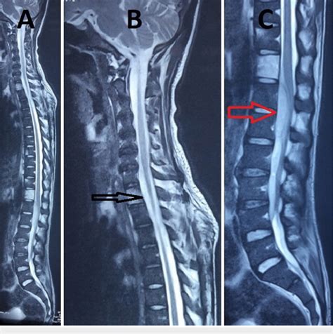 Magnetic Resonance Imaging Mri Of Whole Spine Sagittal Section A