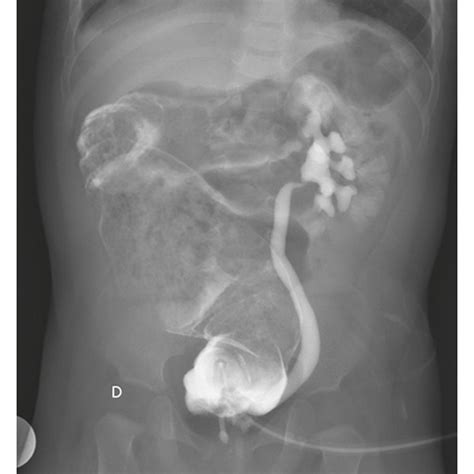 Grade 3 Unilateral Vesicoureteral Reflux Vur With A Thin Tract Download Scientific Diagram