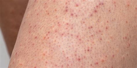 Keratosis Pilaris Chicken Skin Symptoms Causes Treatment Prevention