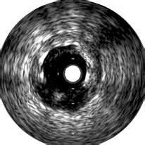 Left circumflex artery lesion. A. Virtual histology analysis prior to ...