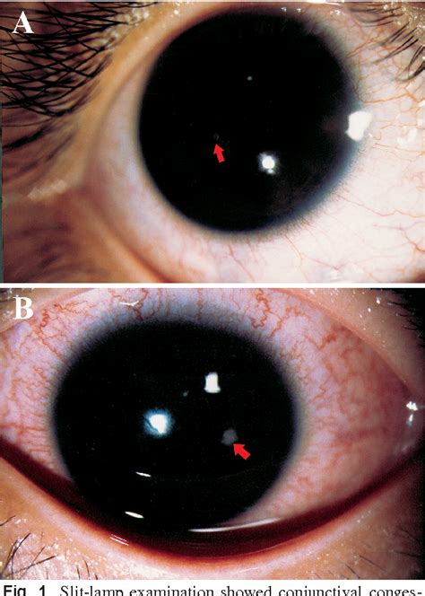 Table 1 From Pseudomonas Aeruginosa Corneal Ulcer Related To Overnight