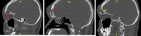 Pott Puffy Tumour Radiology Cases