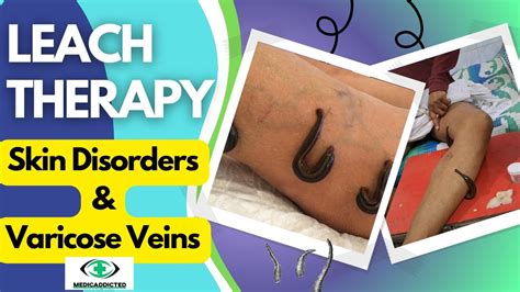 Leech Therapy For Skin Diseases And Varicose Veins Hirudotherapy