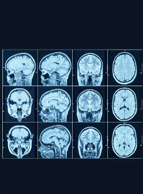 Nueclear | FDG Brain PET CT Scan | Brain PET CT Scan Cost | Nueclear