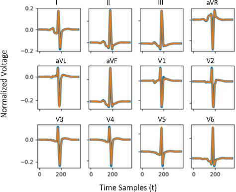 Figure 3 From A Novel Method For 12 Lead Ecg Reconstruction Semantic Scholar