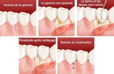 Comment Traiter Le D Chaussement Des Dents Dentiste La D Fense