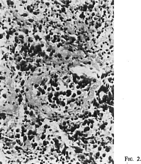 Figure From Il Seminoma Bilaterale Del Testicolo Descrizione Di Un