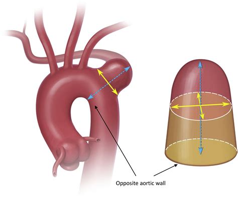 Natural History And Management Of Kommerell S Diverticulum In A Single