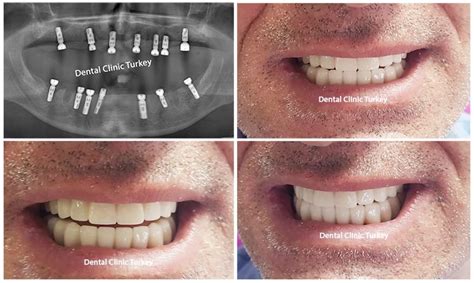 Full Mouth Dental Implants Full Mouth Reconstruction Dental Clinic