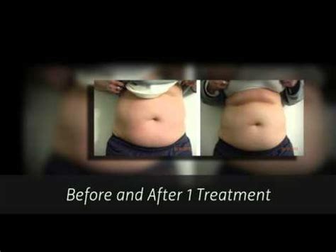 Ultrasonic Liposuction Typical Results Youtube