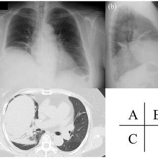 Preoperative Chest Radiography Showed Elevation Of The Right