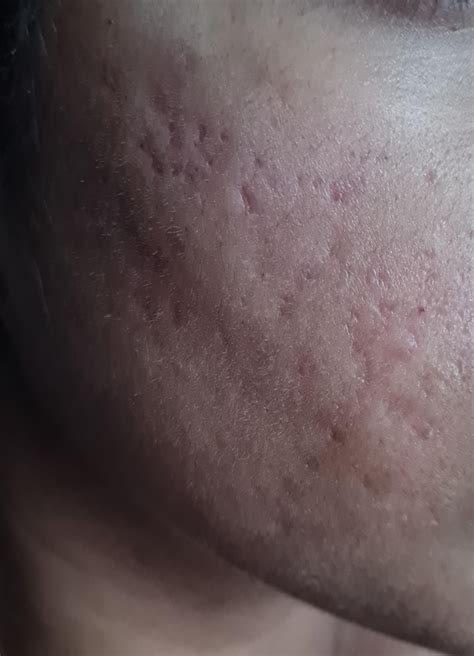 Accutane Remove Acne Scars at Luca Glossop blog