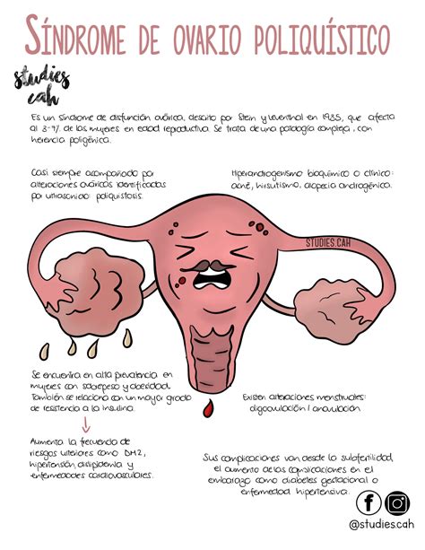 El Ovario Poliquistico Se Cura Petrus Maximinus