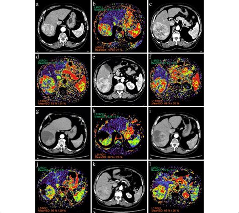 Arterial Phase Images And Corresponding AEF Color Maps Of Three