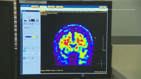 Alzheimer S Clinical Trial Drug Yields Negative Result 11alive