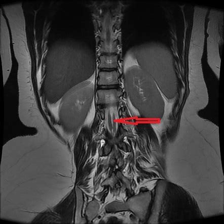 Diastematomyelia | Image | Radiopaedia.org