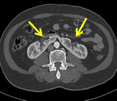 Horseshoe kidney – Radiology Cases