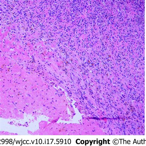 Histopathological Examination Of The Resected Mass Showed Inflammatory