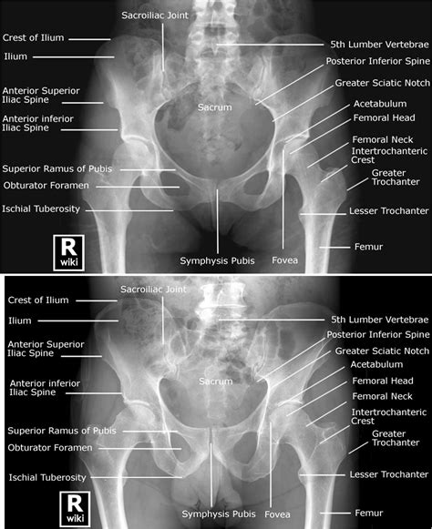 Labeled Radiographic Anatomy Of The Male Bottom Image And Female Top Image Pelvis Human