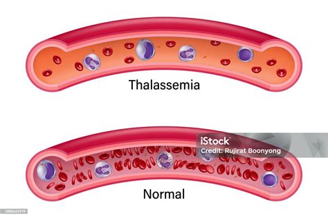 Perbandingan Antara Sel Darah Merah Normal Dan Thalassemia Pendidikan