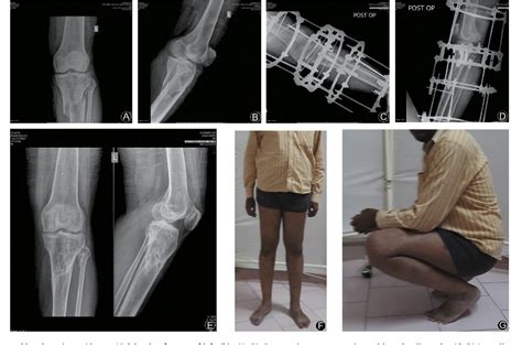 Figure 1 From Outcome Of Complex Tibial Plateau Fractures With Ilizarov