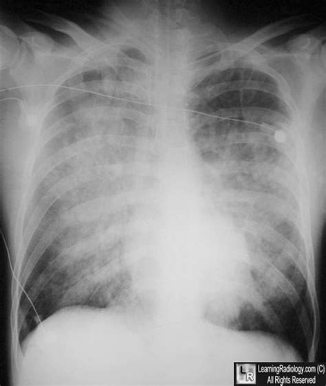 Learning Radiology - Congestive Heart Failure, Pulmonary Edema