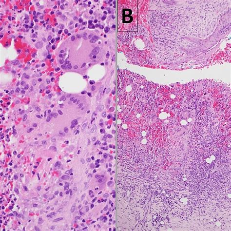 Histopathology Of Punch Biopsy Of One Of The Ulcerated Skin Lesions On