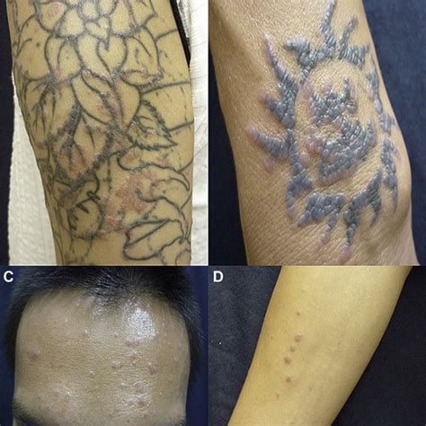 Multiple Flat Topped Erythematous Papules On A The Left Upper Arm And