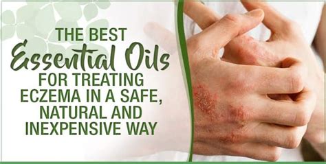 The Best Essential Oils For Treating Eczema In A Safe Natural And Inexpensive Way Essential