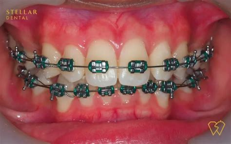 Braces Color Chart Lennoxadrienne