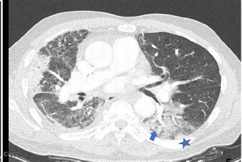 Chest Ct Imaging Ground Glass Opacity Central Basal Posterior Left Download Scientific