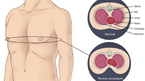 What is Pectus Excavatum?