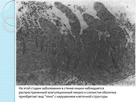 Ишемический колит - презентация онлайн